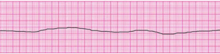 What are the Two Non-Shockable Rhythms in Cardiac Arrest? – Free CPR ...