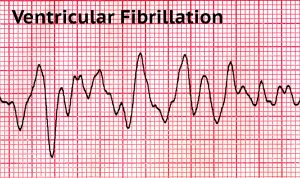 What are the Two Shockable Rhythms in Cardiac Arrest? – Free CPR Training