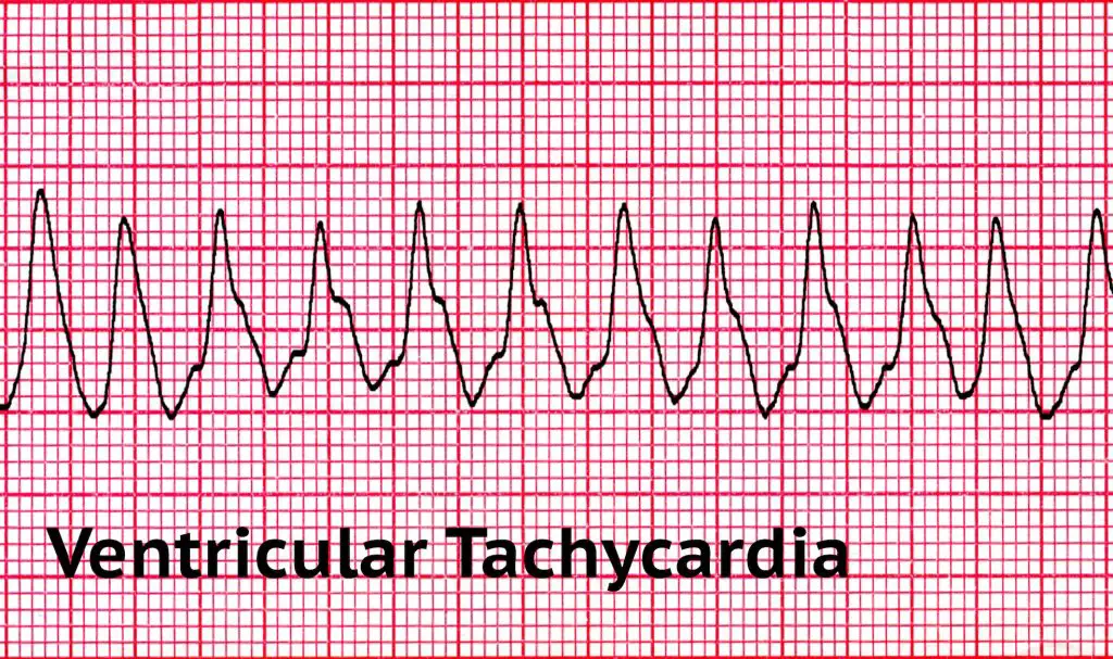 What are the Two Shockable Rhythms in Cardiac Arrest? – Free CPR Training