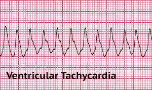 What are the Two Shockable Rhythms in Cardiac Arrest? – Free CPR Training