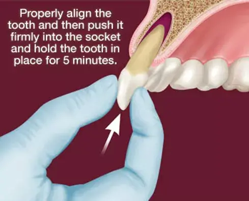 How to Save a Knocked Out Tooth